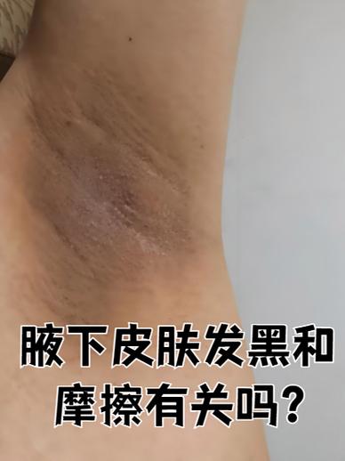 腋下发黑怎么去除