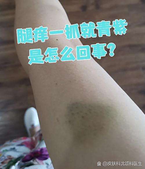 身上痒一挠就发紫是怎么
