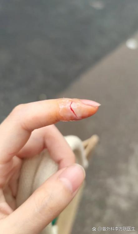 被水果刀切到手指很深怎么办
