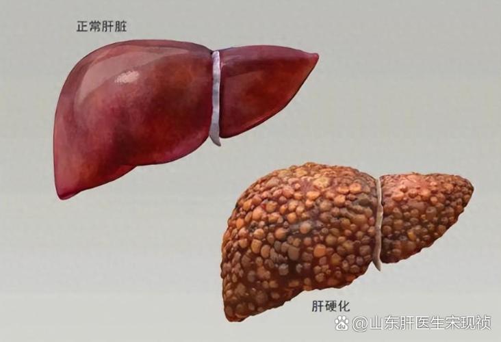 乙肝是很严重的病吗
