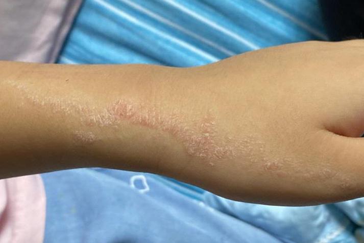 手上长像疤一样的白线