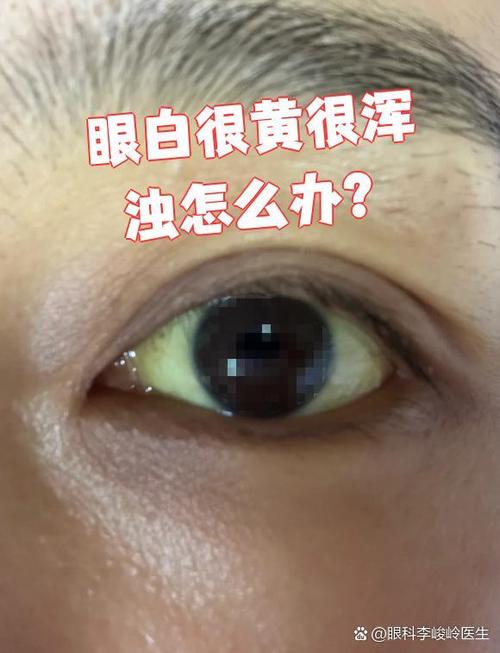 眼球发黄是怎么回事儿