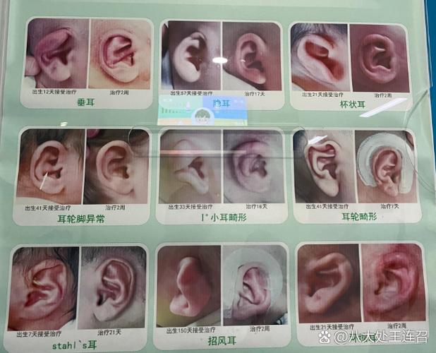 隐耳有必要矫正吗