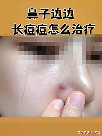 让痘痘快速消红的方法