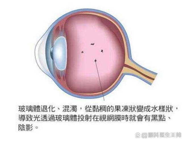 双眼玻璃体混浊是什么意思