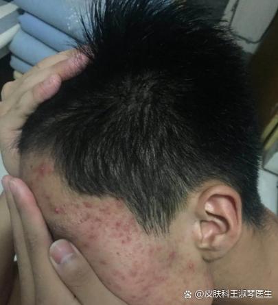 痘消了以后会有黑色