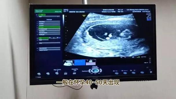 孕44天有胎心内有暗区什么意思