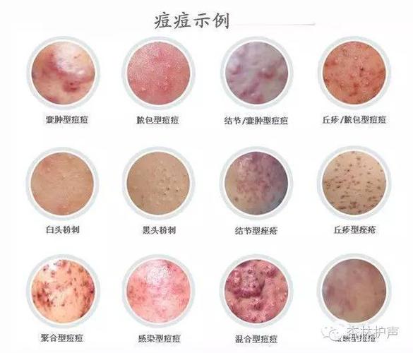 起痘位置原因对照图