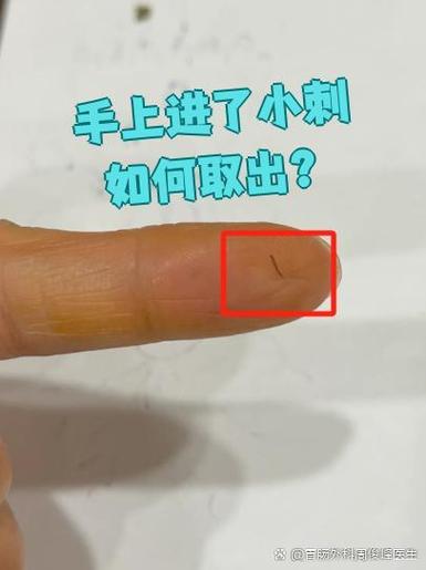 手里扎入小刺刺看不见如何取出