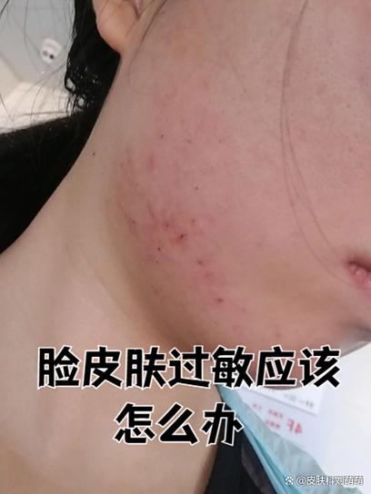 过敏老是反复发作怎么办
