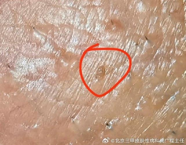 生殖长红疙瘩不疼不痒