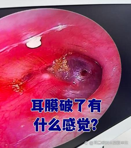 耳膜破了会聋吗