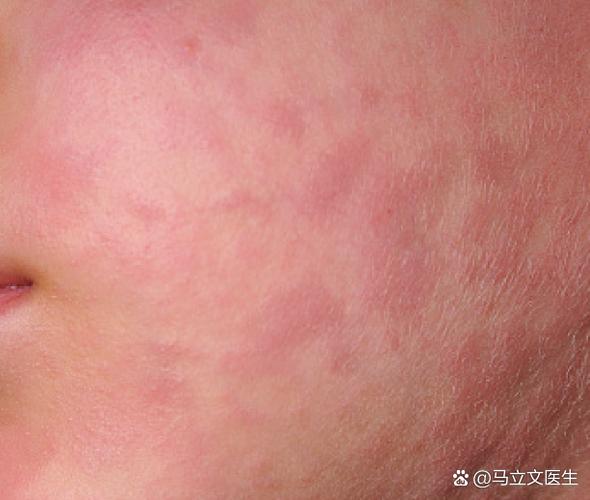 荨麻疹暗示身体哪里出问题了