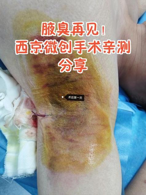 腋臭手术一般多少钱正规医院游戏截图