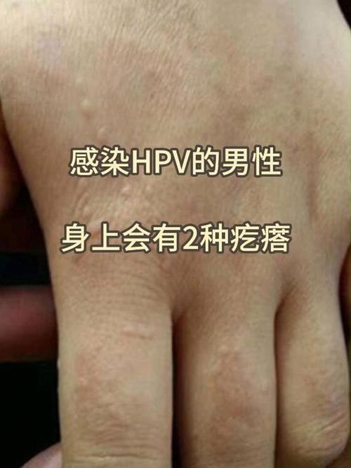 男性得了hpv有什么症状