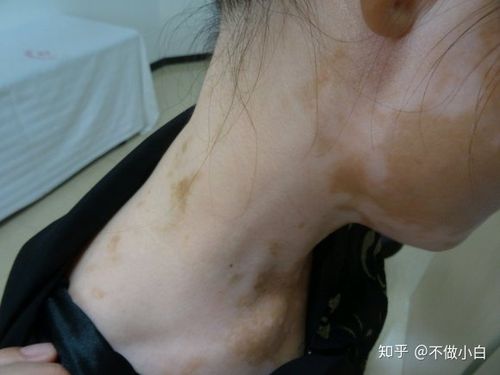 白癜风打一针580效果如何