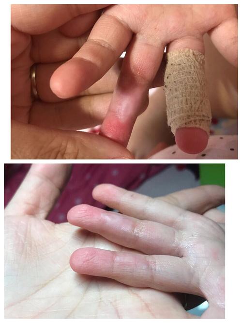 小孩被跑步机磨伤手指