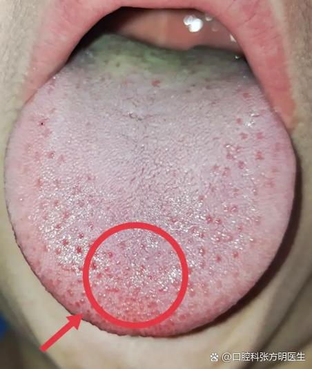 舌头刺痛什么原因引起的缩略图