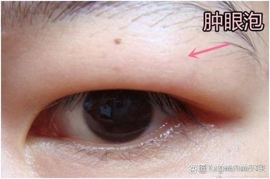 肿眼泡