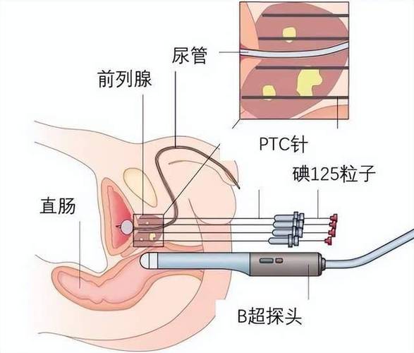 不到最后不用粒子植入