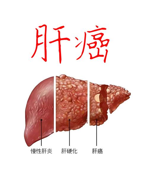 llb期肝癌还属于早期吗