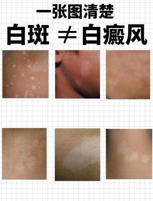 烫伤后白斑的图片缩略图