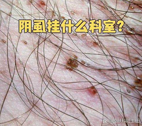 阴虱去医院要花多少钱缩略图