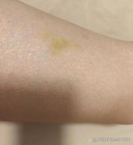 用碘伏周围皮肤变色