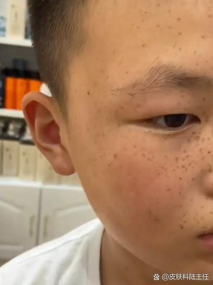 小孩脸上有雀斑怎样才能去掉