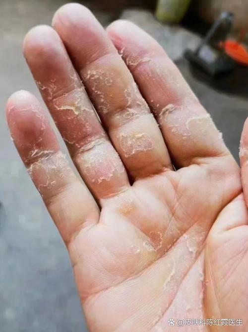 手指脱皮指纹会变吗