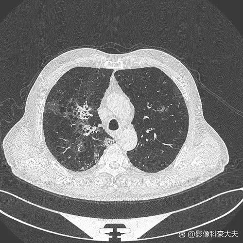 单次多层ct平扫能检查出什么