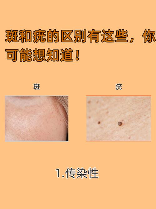 肉粒和疣的区别图片截图