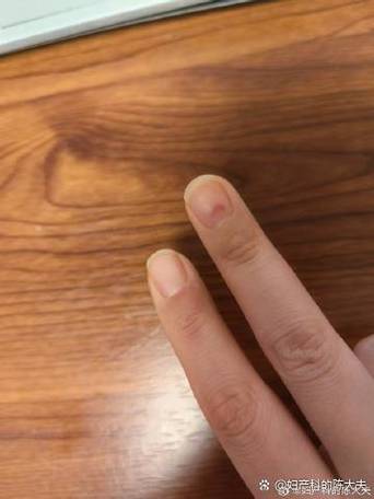 削苹果手破了怎么办