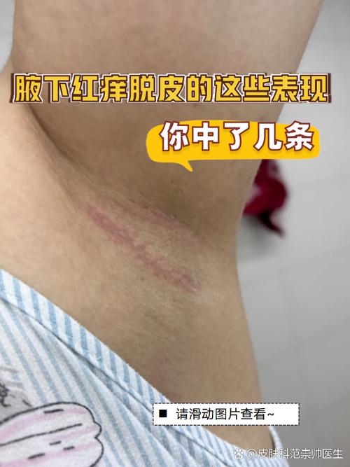 嘎吱窝很痒是什么原因