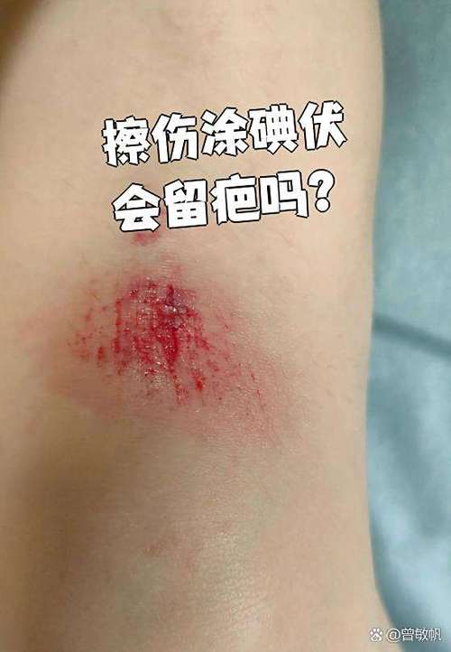 碘伏涂皮肤上会留黑印吗