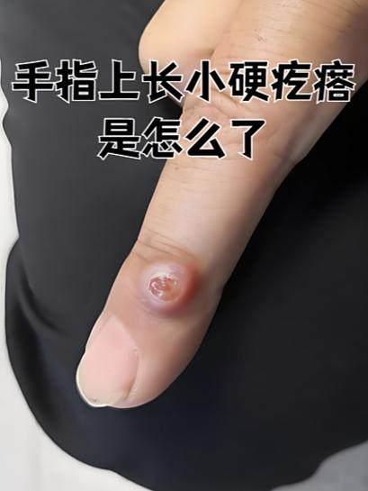 牛牛皮上长个硬硬的小疙瘩