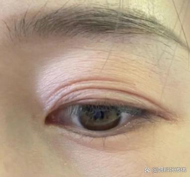 眼部皮肤松弛怎么处理