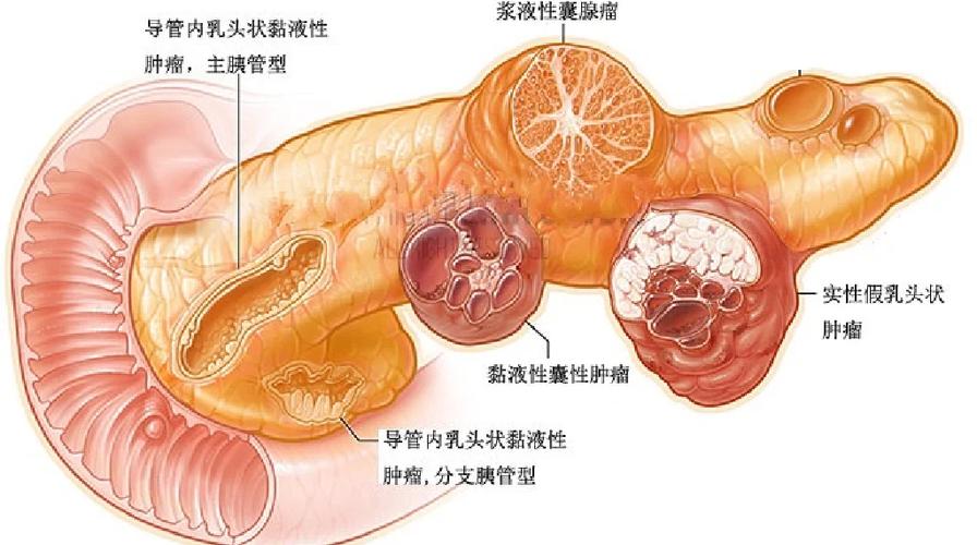胰腺肿瘤