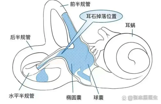 听耳机会引起耳石症吗