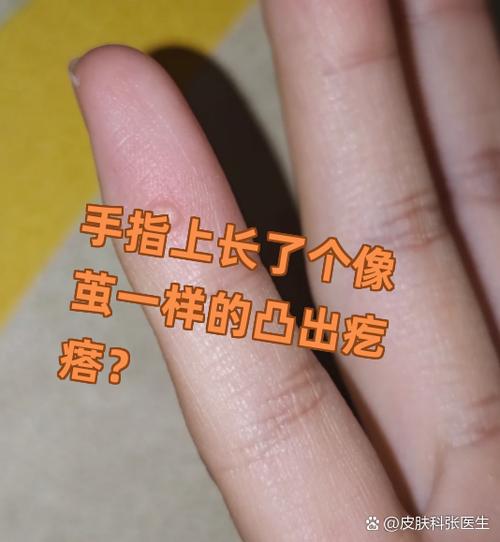 手指上长了个像茧一样的凸出疙瘩