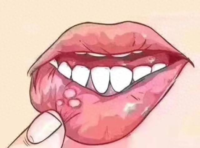 口腔溃疡一般要痛几天