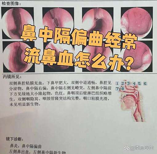 鼻炎会经常流鼻血吗