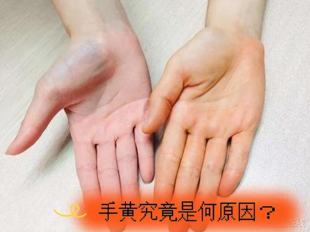 手发黄怎么调理