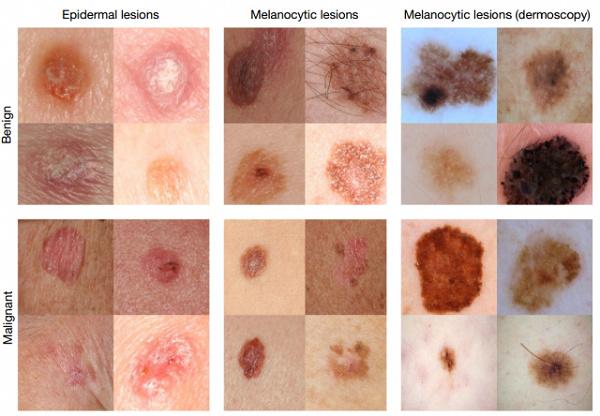 melanocytic