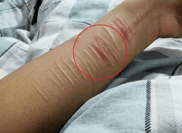 刀片能割开手腕吗