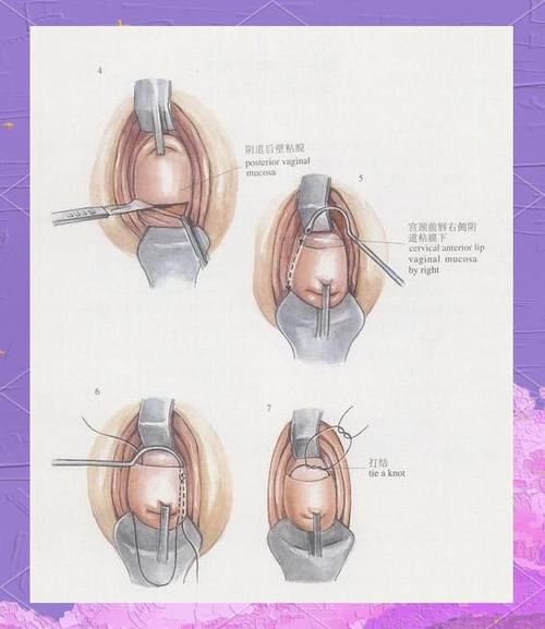 阴壁修复手术是怎么做的