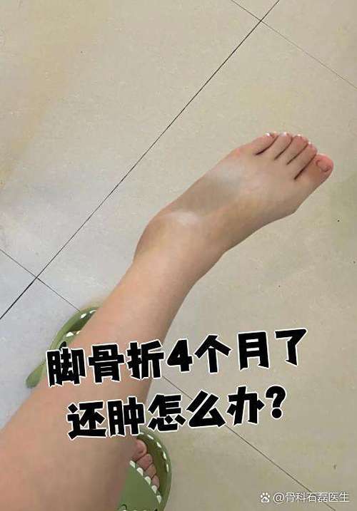 骨子断了会肿吗