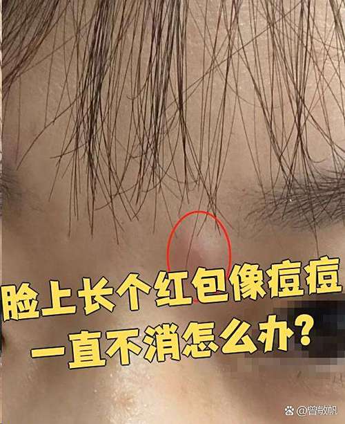 脸上长红包不痛不痒怎么办缩略图