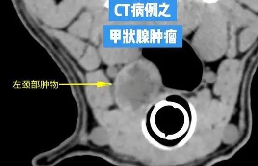 甲状腺结节低回声好还是强回声好