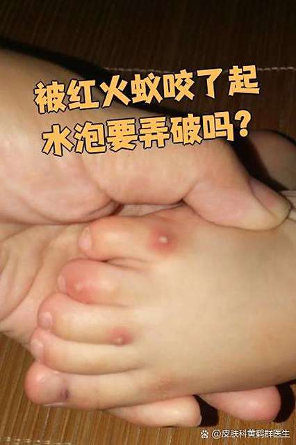 被红蚂蚁咬了会怎么样